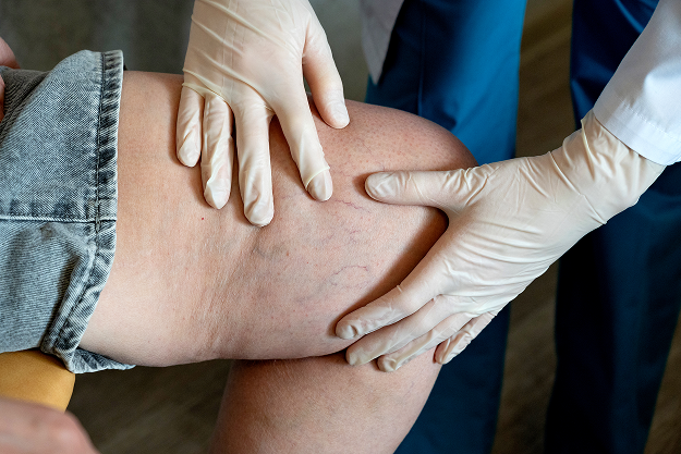 Lenfödem terapisi örnek fotoğrafı 2